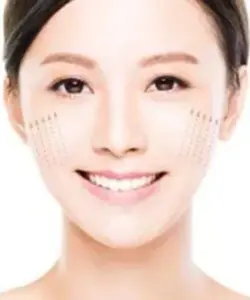 30 Threads Face & Neck Lift