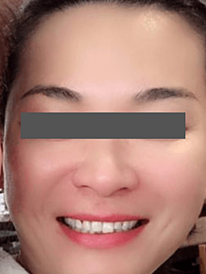 FOREHEAD, MARIONETTE LINES AND NASOLABIAL FOLDS (FILLERS) After