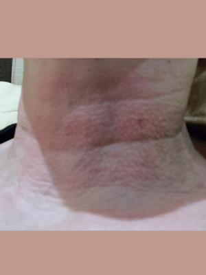 NECK (FILLERS) Before