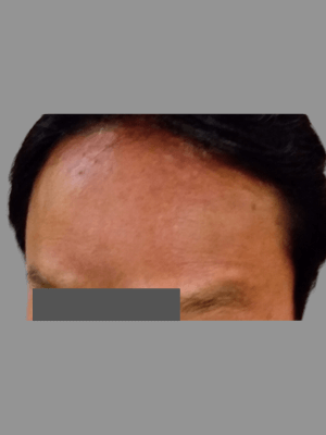 FROWN AND GLABELLAR LINES (BOTOX) After