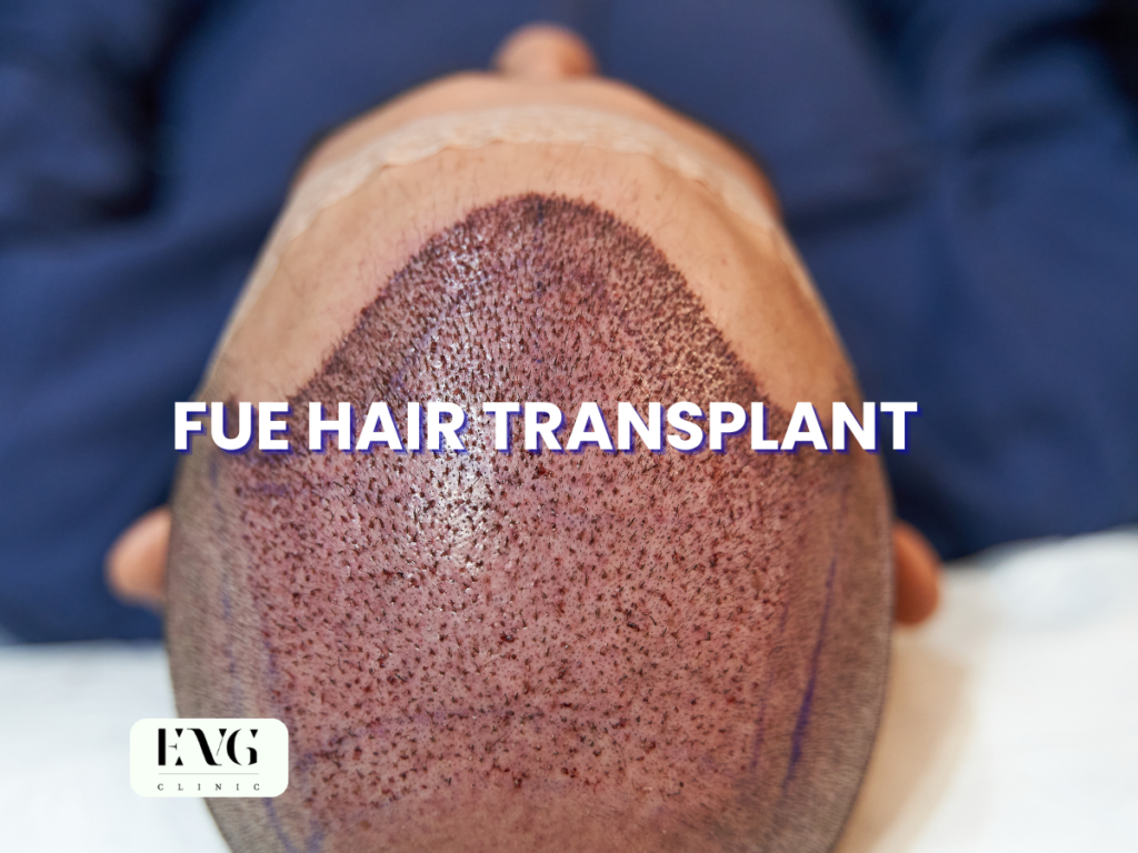 Hair Transplant in Malaysia