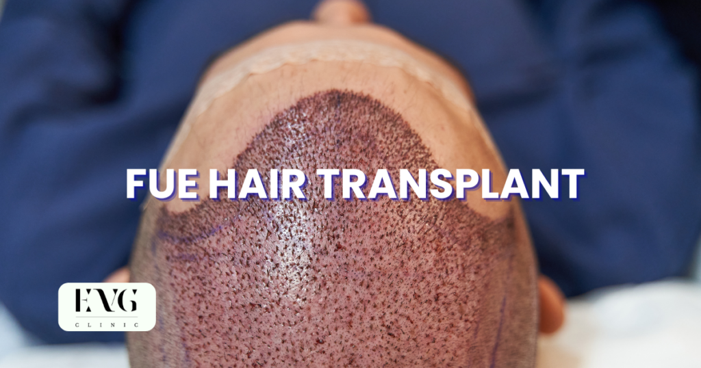 FUE HAIR TRANSPLANT